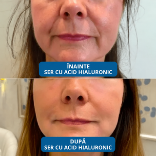Ser cu Acid Hyaluronic