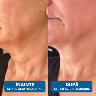 Ser cu Acid Hyaluronic